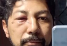 Veterinário roraimense faz campanha virtual para pagar cirurgia de reconstrução no rosto após sofrer acidente com cavalo